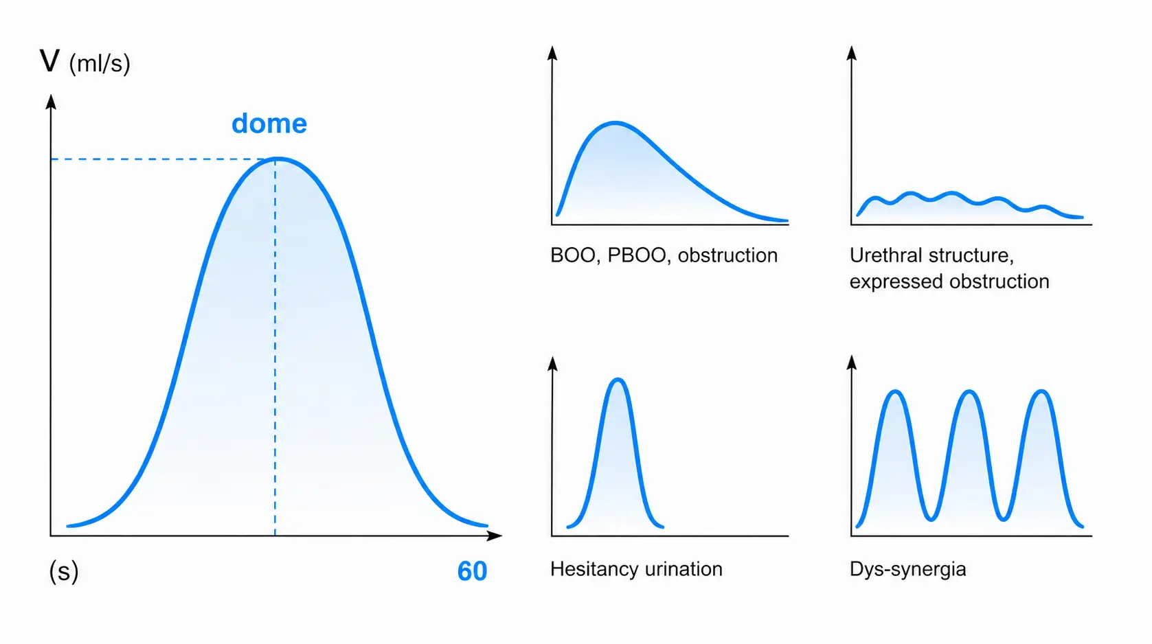 Three typical uroflowmetry curves — bell (normal), plateau (obstruction), staccato (dyssynergia)